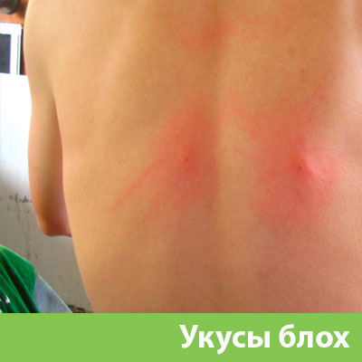 Укусы блох в Брянске