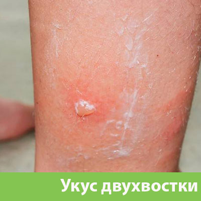 Укус двухвостки в Брянске