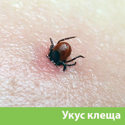 Укус клеща в Брянске