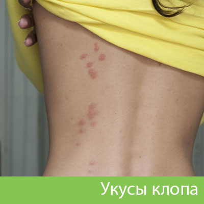 Профессиональное уничтожение клопов в Брянске